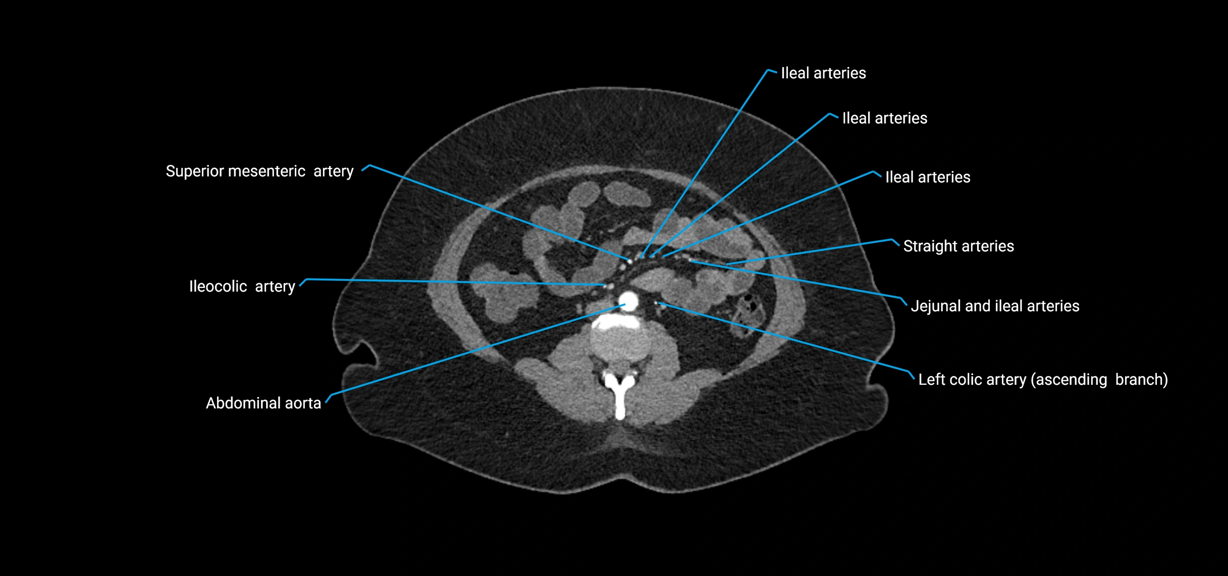 CTA abdomen axial cross sectional anatomy labelled image_106 (2).webp